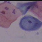 Κοιλοκυττάρωσης και υπερκεράτωσης.